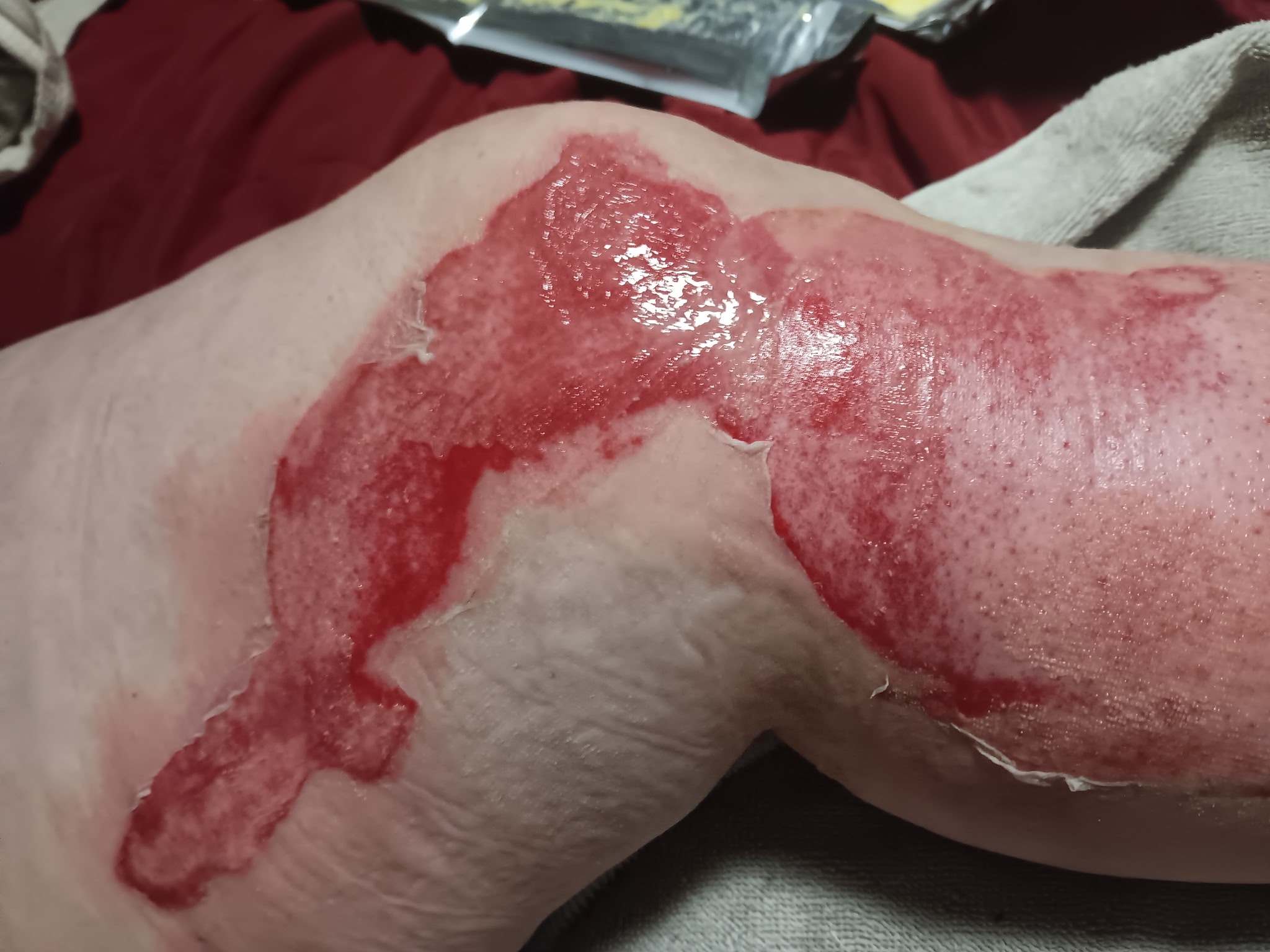 Support Brandi’s Recovery After Burn Accident campaign photo, 5 of 6