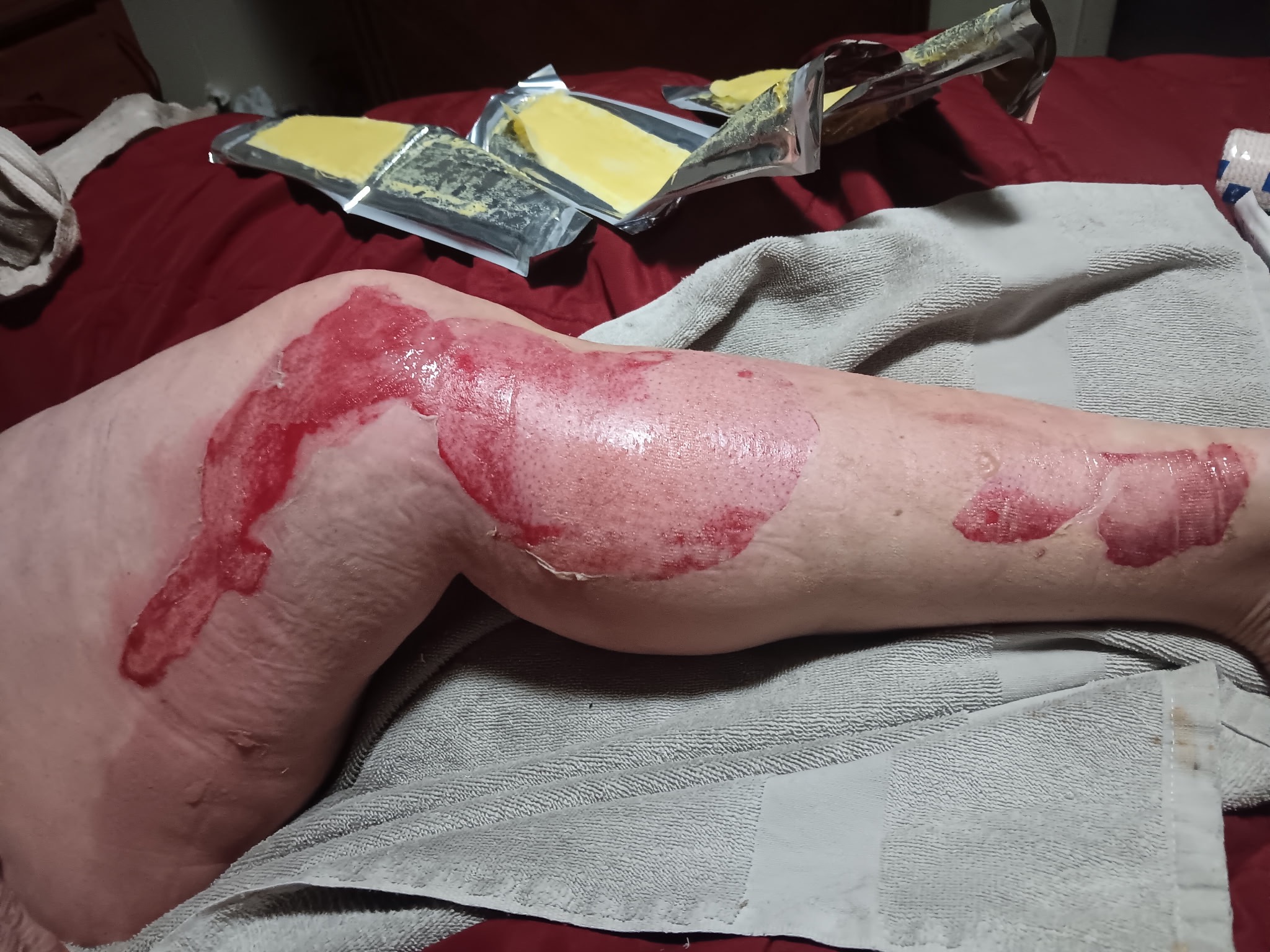 Support Brandi’s Recovery After Burn Accident campaign photo, 4 of 6