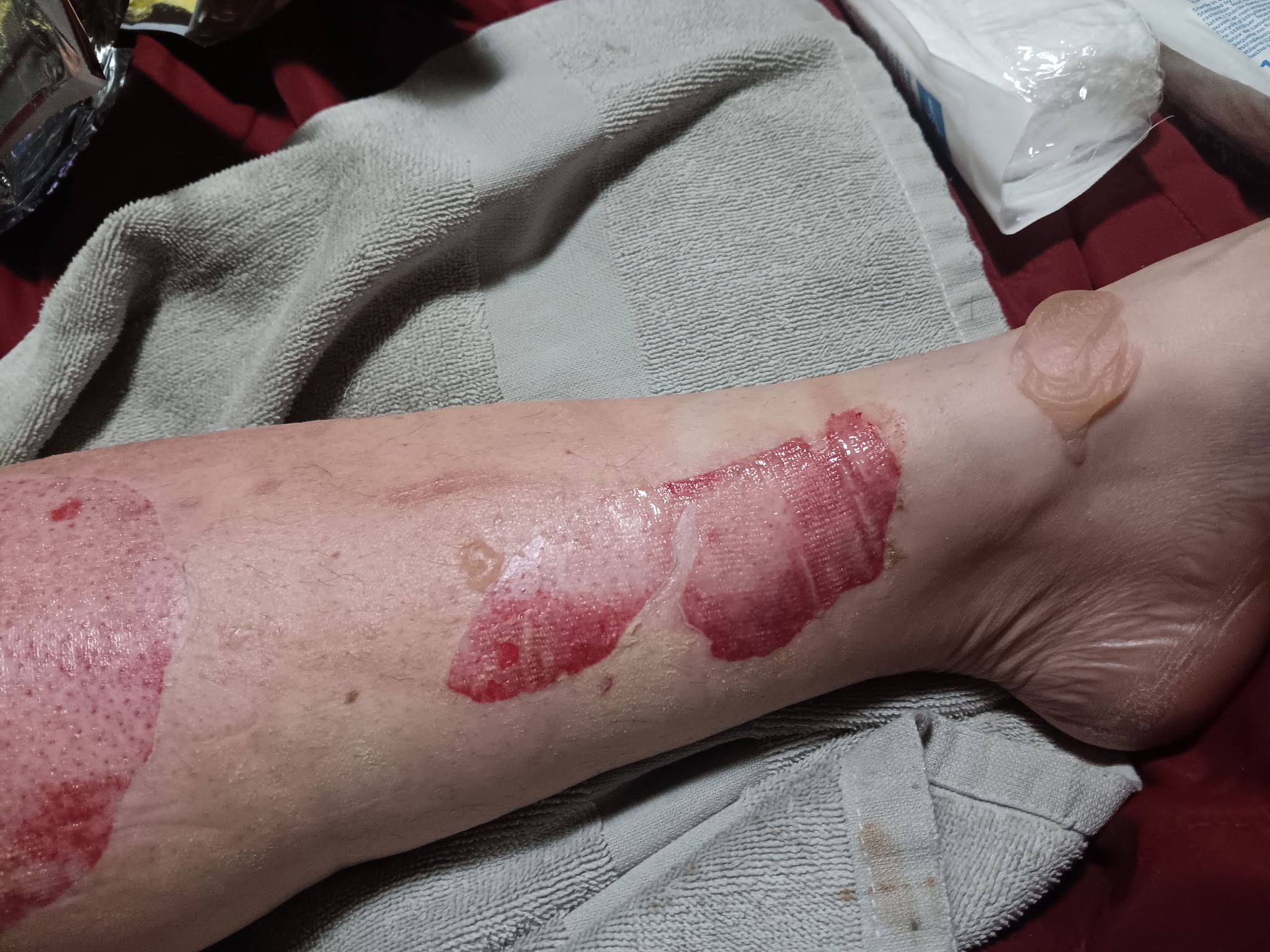 Support Brandi’s Recovery After Burn Accident campaign photo, 2 of 6