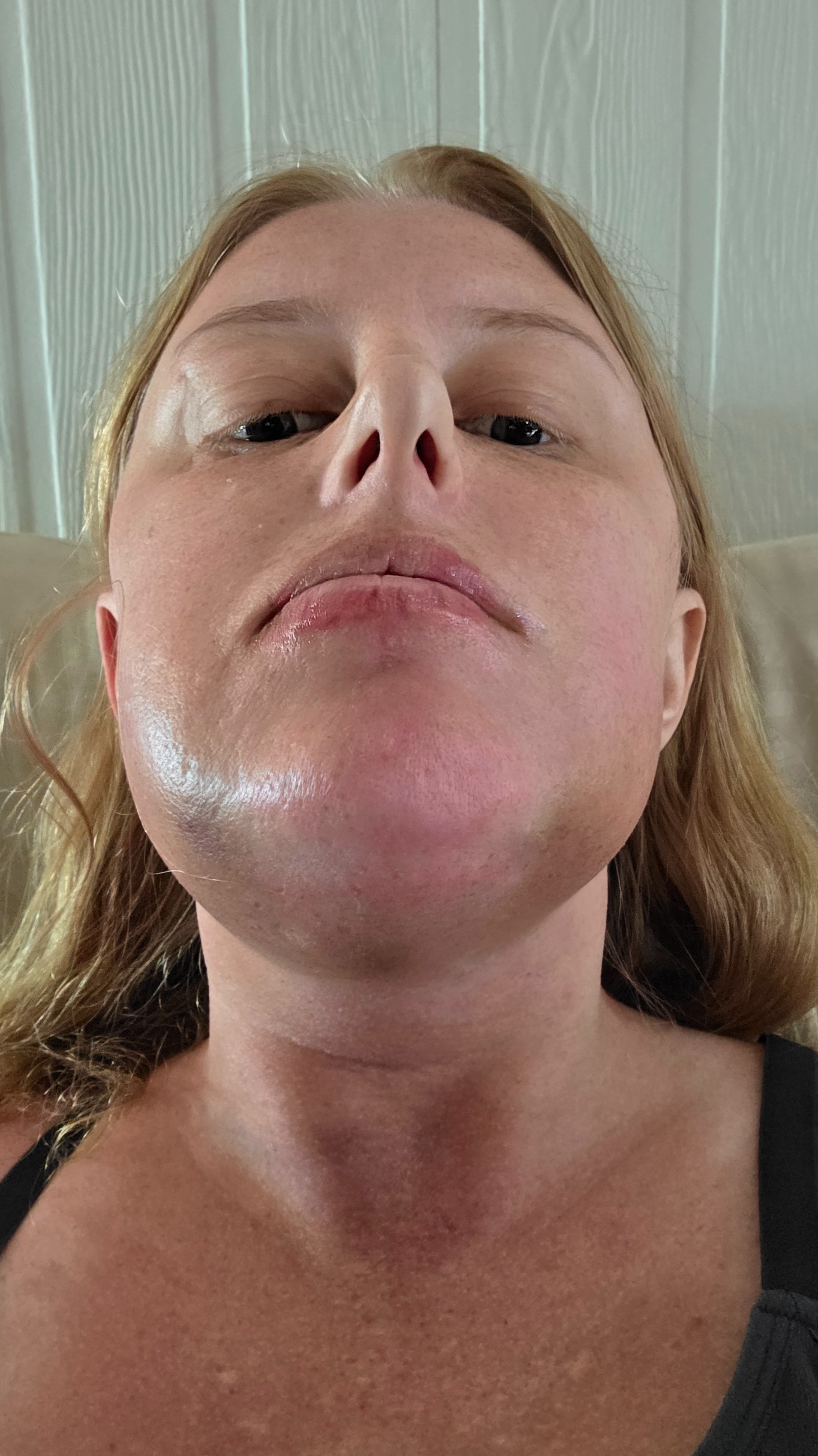 My jaw joint replacement campaign photo, 2 of 8