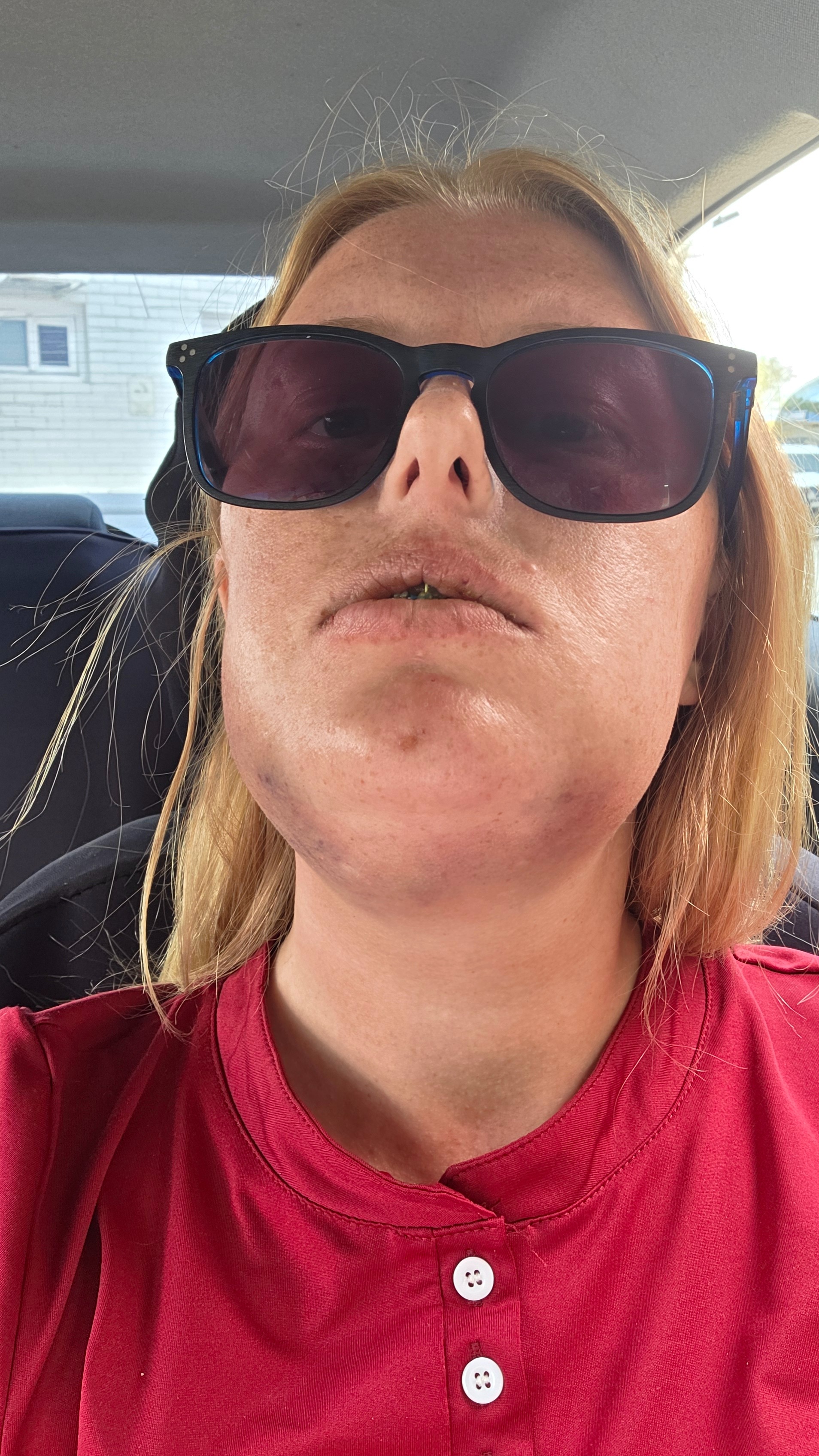 My jaw joint replacement campaign photo, 5 of 8