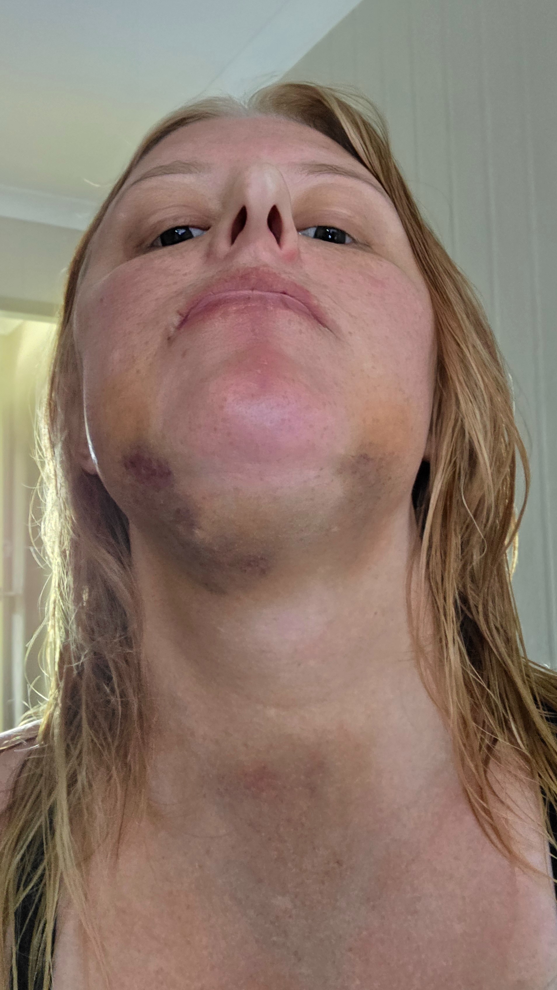 My jaw joint replacement campaign photo, 4 of 8