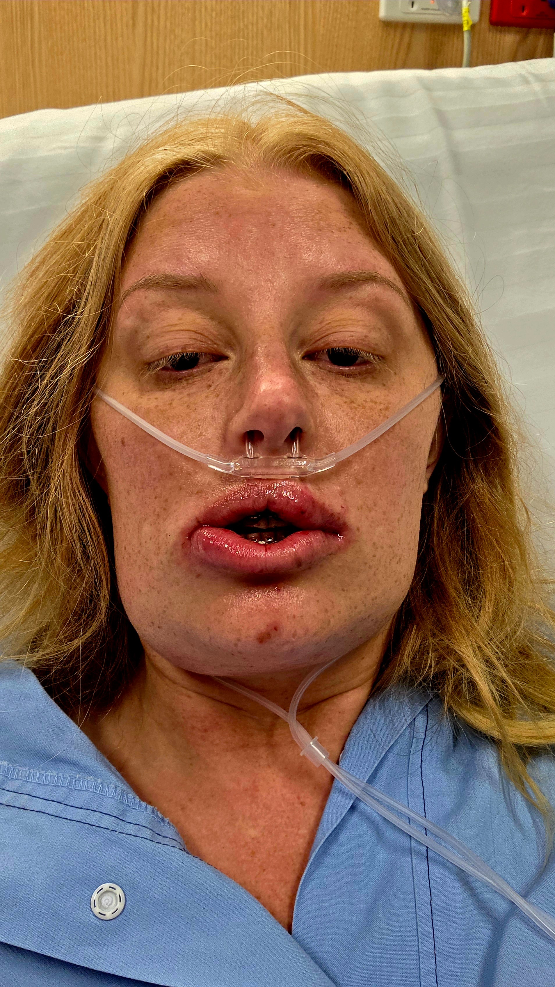 My jaw joint replacement campaign photo, 6 of 8