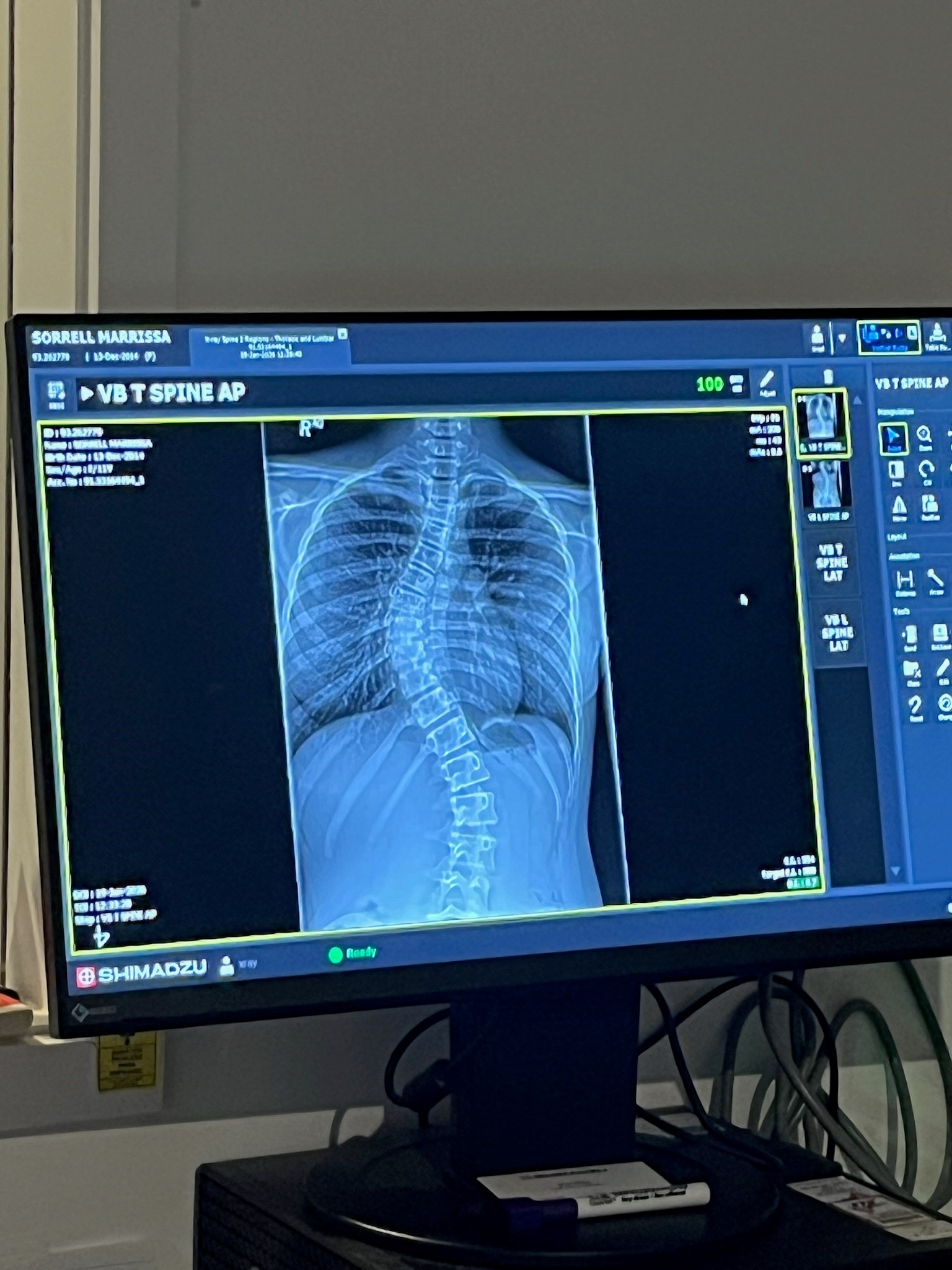Help Marrissa access life-changing spine surgery campaign photo, 5 of 6
