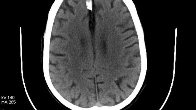 Support Andre's Fight Against Meningioma photo