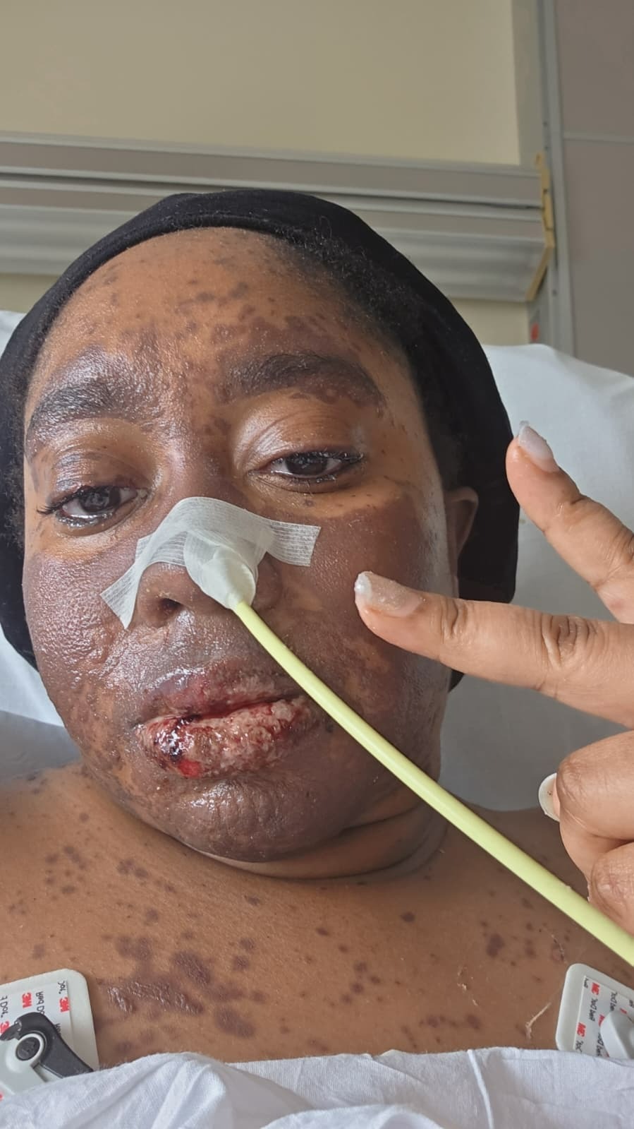 Help Angie Heal from Stevens-Johnson Syndrome campaign photo, 2 of 7