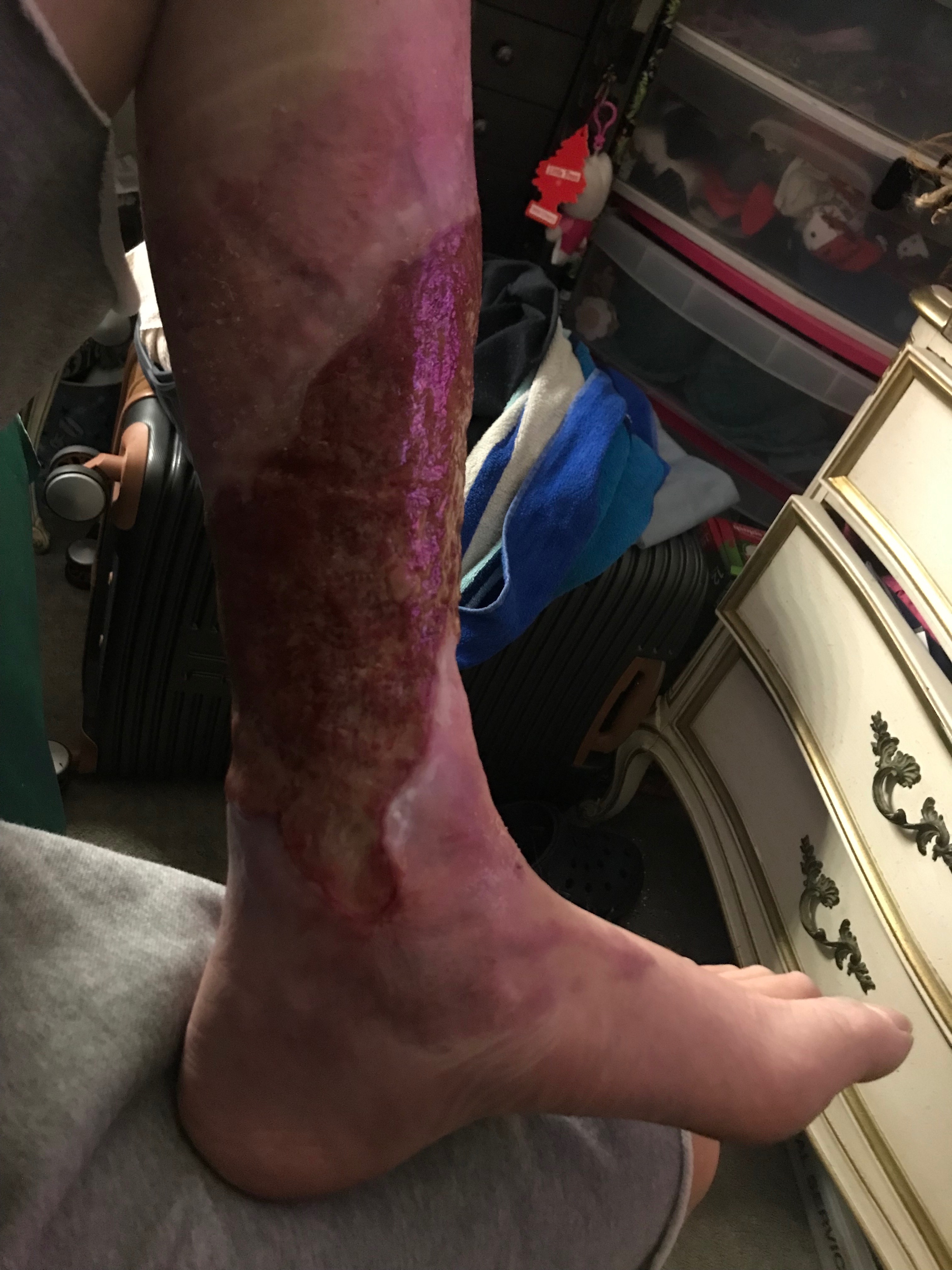 Help Timothy Recover After Motorcycle Accident campaign photo, 4 of 8