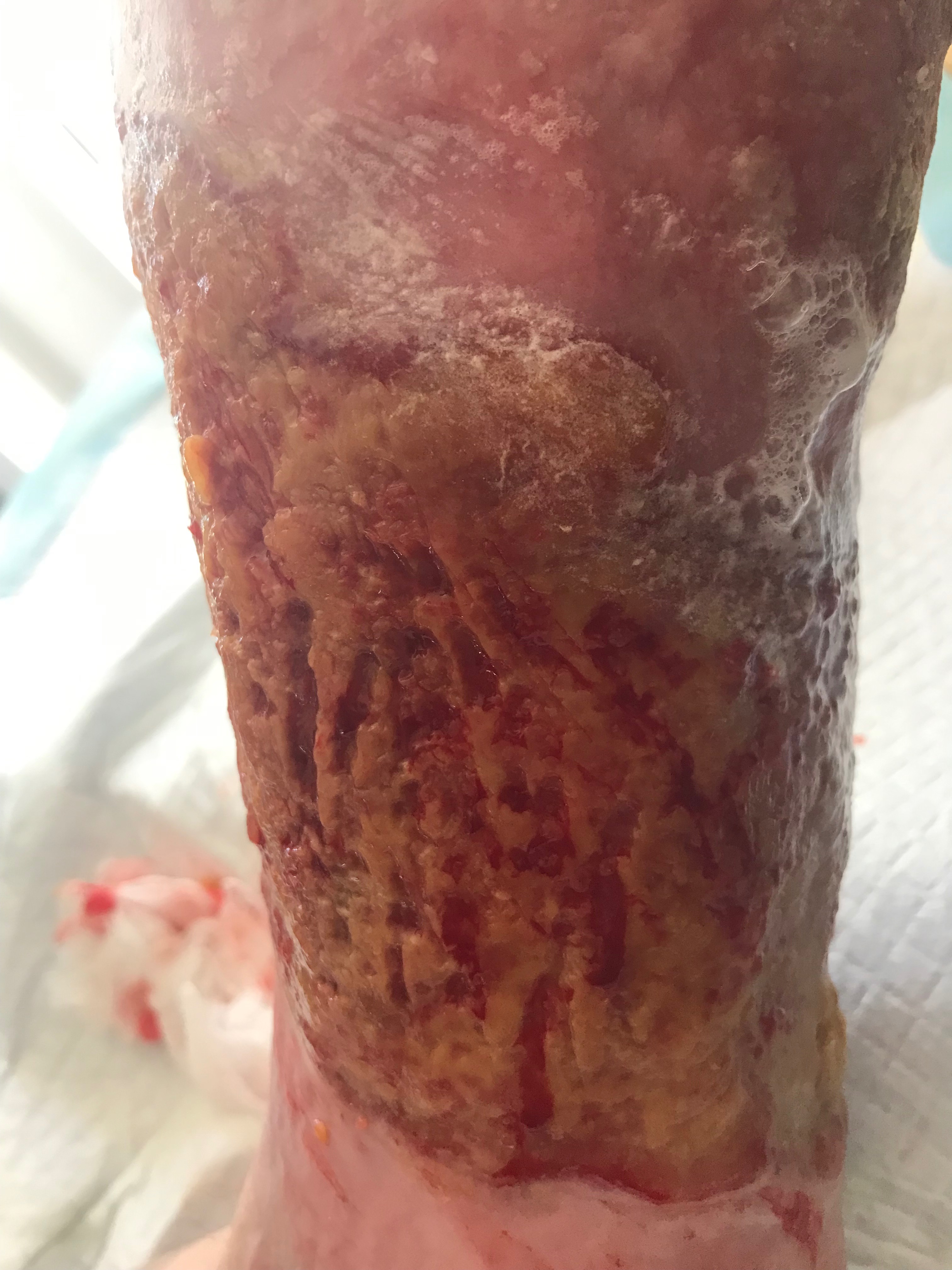 Help Timothy Recover After Motorcycle Accident campaign photo, 6 of 8