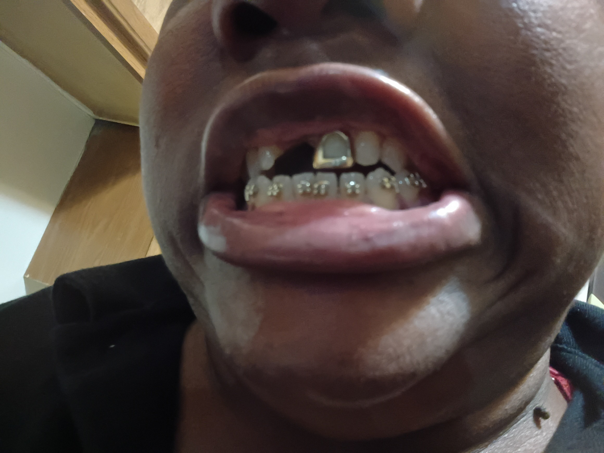 Help Brandy Fix Her Front Tooth campaign photo, 2 of 4