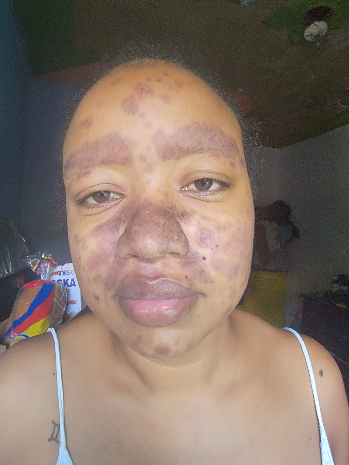 Help Akeena with Medical Costs for Lupus & Kidney Care campaign photo, 2 of 7
