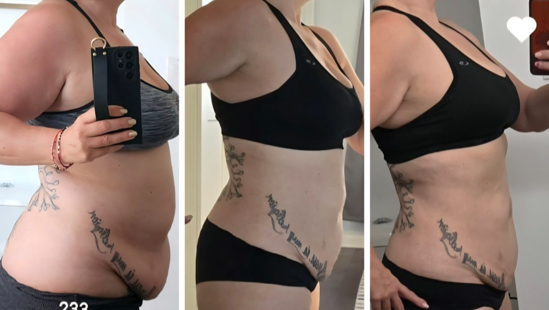 65 lbs Down… My Stomach Didn’t Get the Memo (MMC) photo