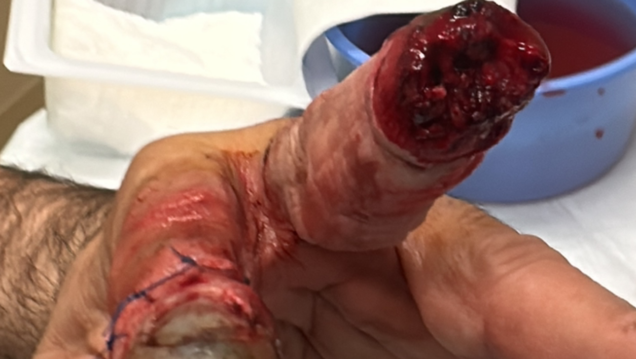 Acidente de trabalho Workplace accident photo