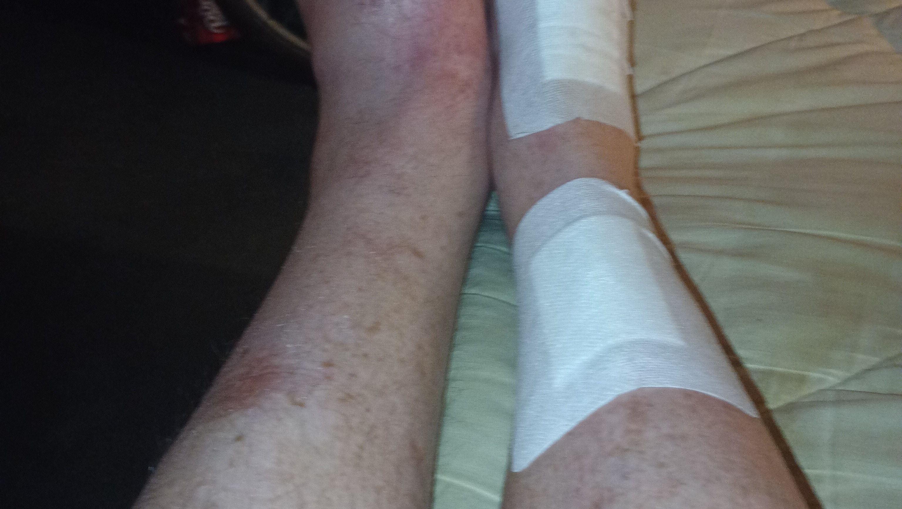 Support for My Recovery After Foot Loss