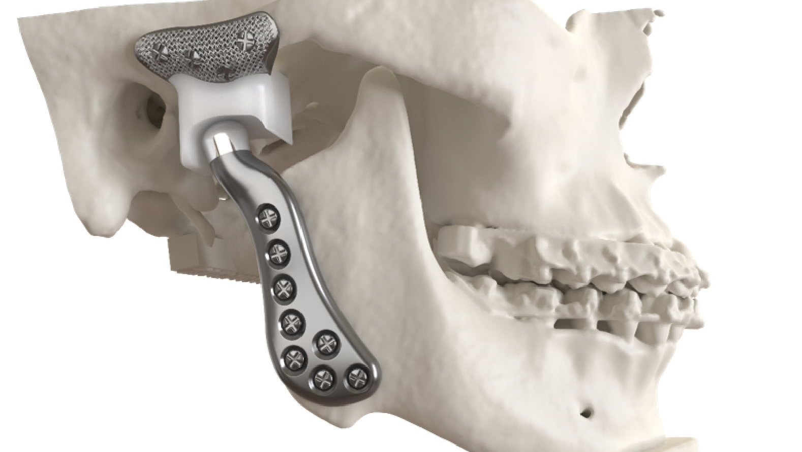 Shiv needs urgent jaw & TMJ joint treatment & surgery photo