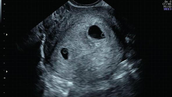 Donate to help my twins medical photo